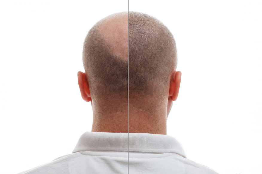 Huvudet på en man före och efter hårtransplantation